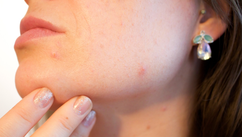 피지낭종 생긴 이유와 제거 방법 관련 사진