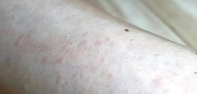 피부 붉은반점 30