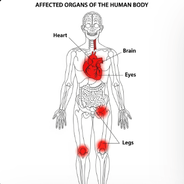 고지혈증과 고혈압 관계7
