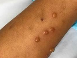 원숭이두창 증상