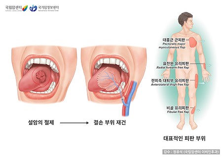설암 초기증상