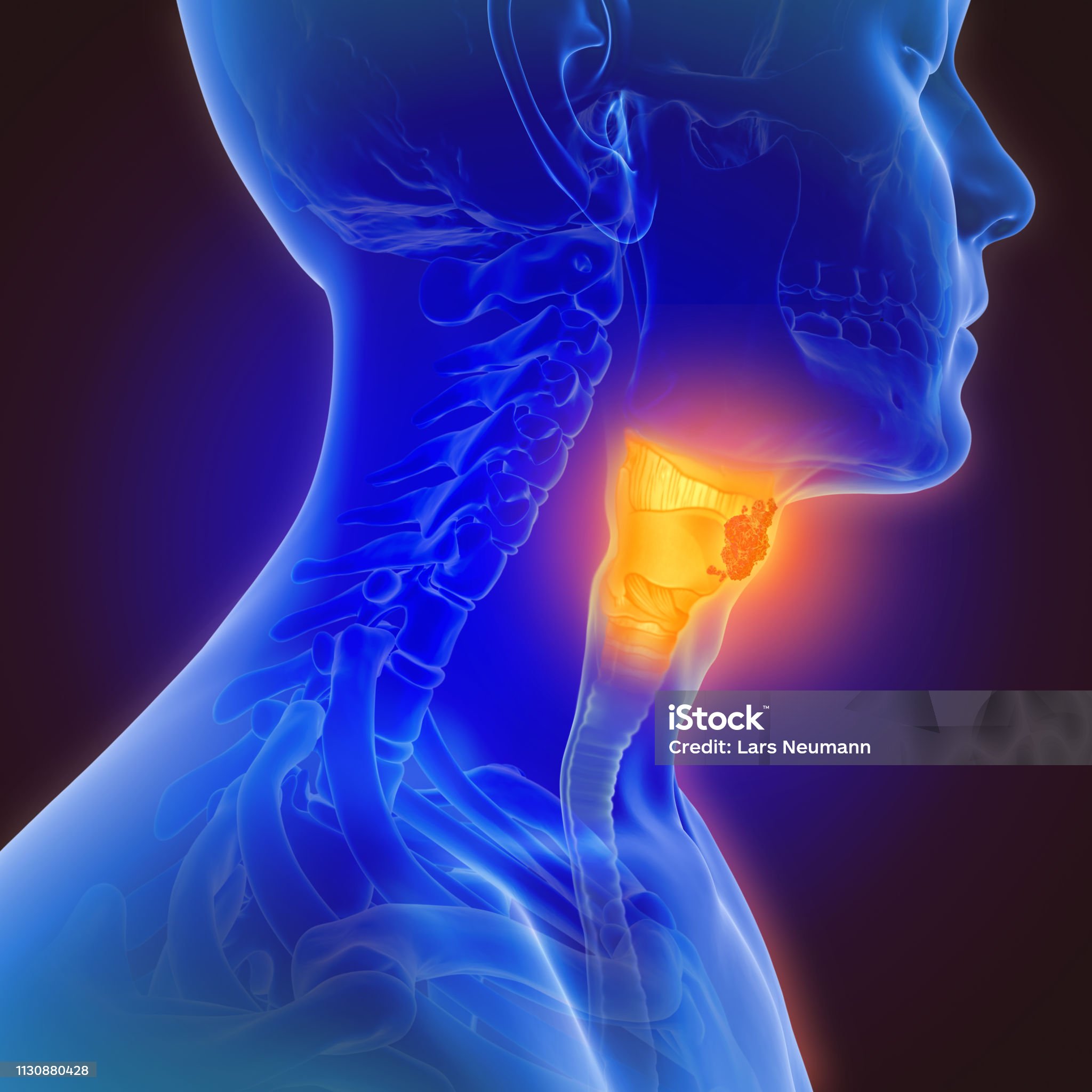 후두염, 가래, 콧물, 목 통증, 감염, 목아픔