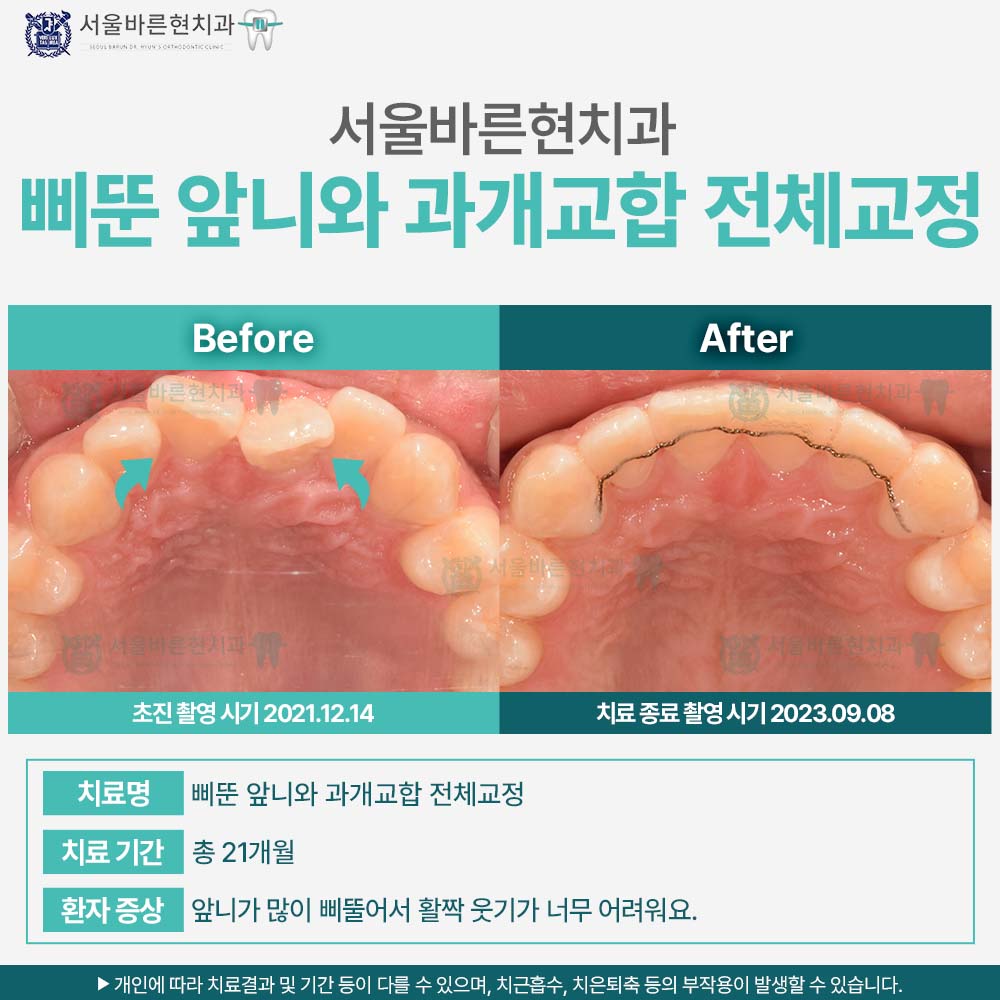 해운대치아교정