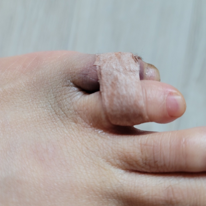 새끼발가락 테이핑