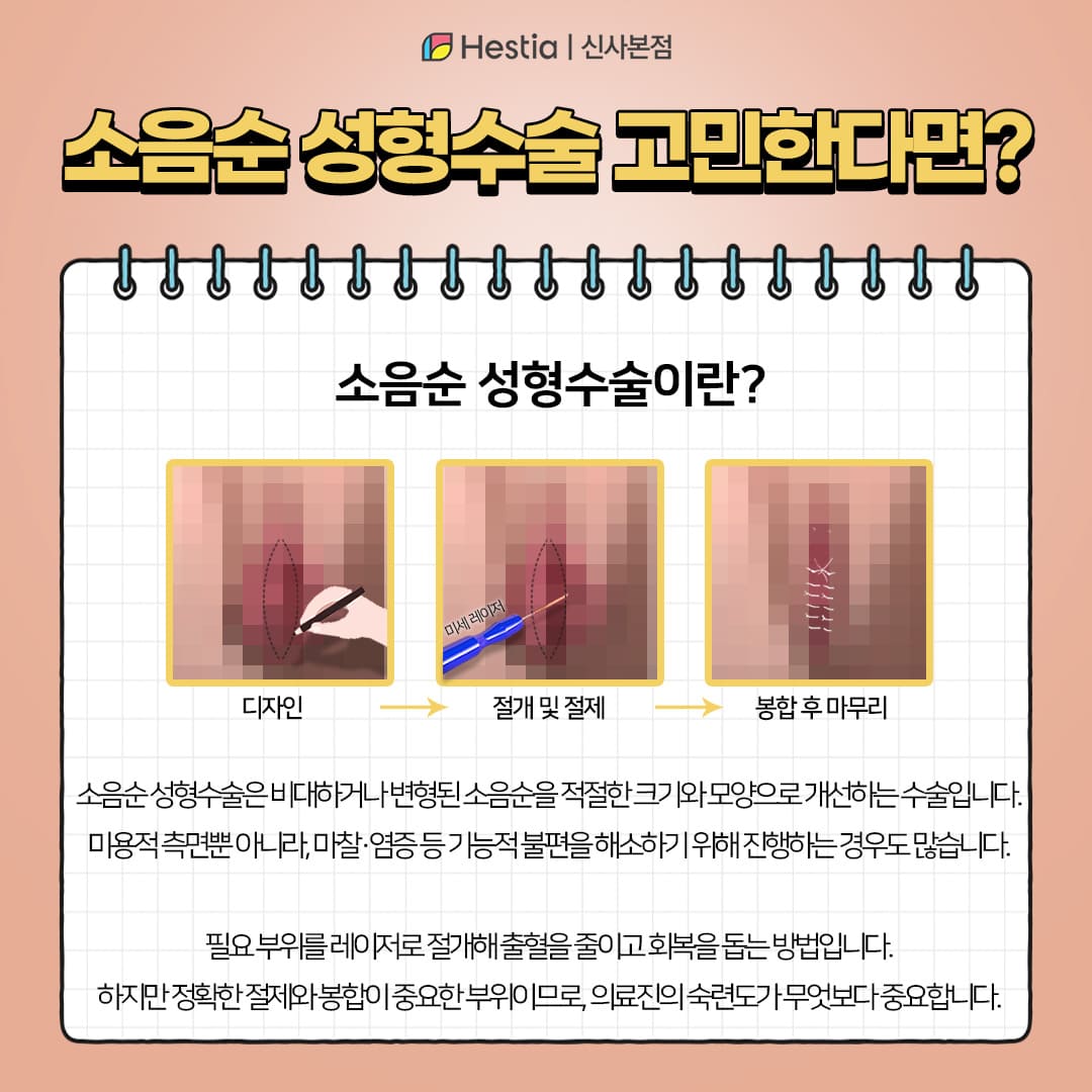 소음순성형수술을 고민한다면?