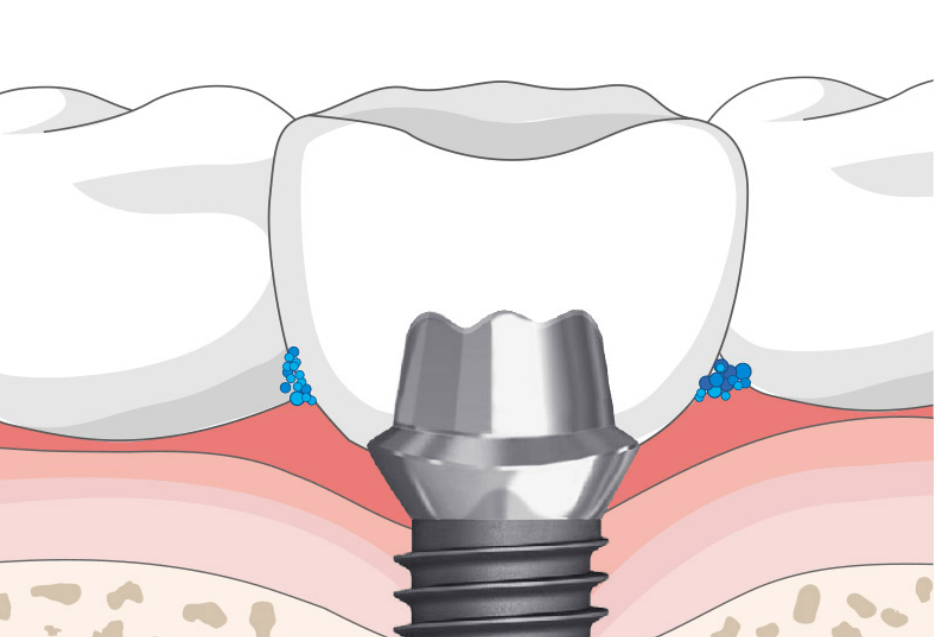 평택-임플란트-잘하는-치과-평택-임플란트-유명한-곳-평택-임플란트-가격