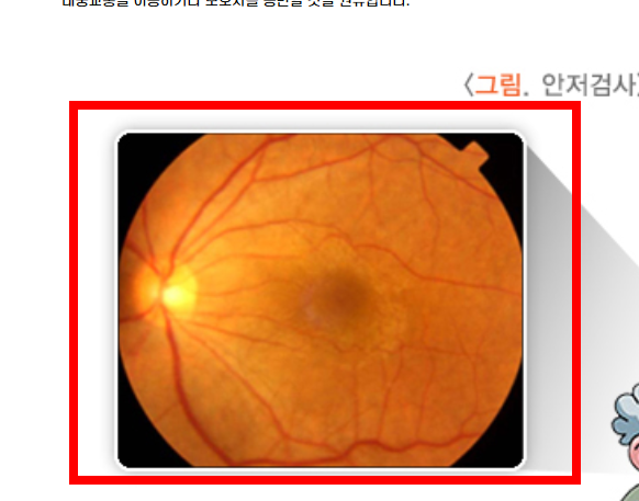 비문증 치료방법 알아보기