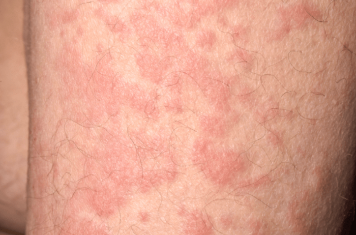 알레르기성 두드러기의 원인과 치료법