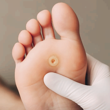 티눈 없애는 방법