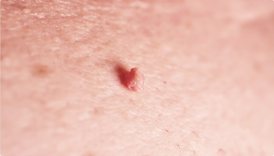 쥐젖이 생기는 이유