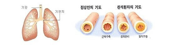 천식과 기도