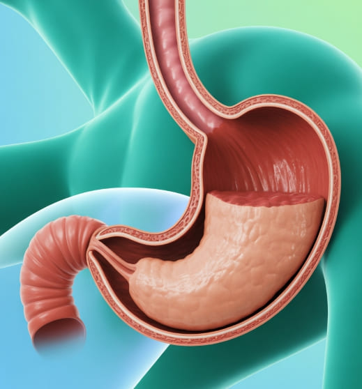 역류성식도염 증상 (음식, 치료법)