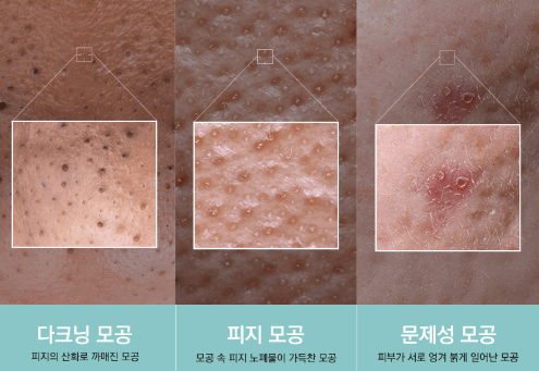 모공 확장 원인