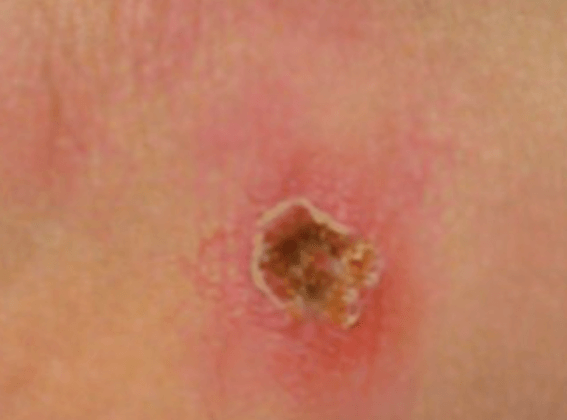 츠츠가무시증 딱지