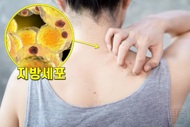 허리둘레 85cm 33인치 건선,팁줌