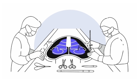 담도암 수술과정