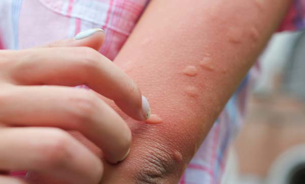 모기에 물린 자리가 크게 부어오른 모습 - 스키터증후군 발생