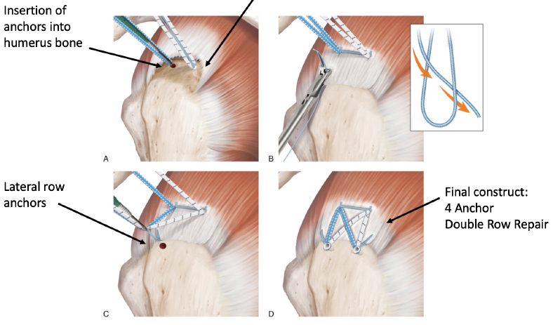 회전근개 봉합술