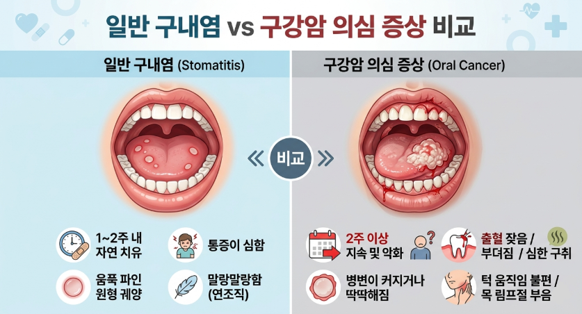 구내염(아프타성 궤양, 헤르페스 구내염, 면역력, 구강암)