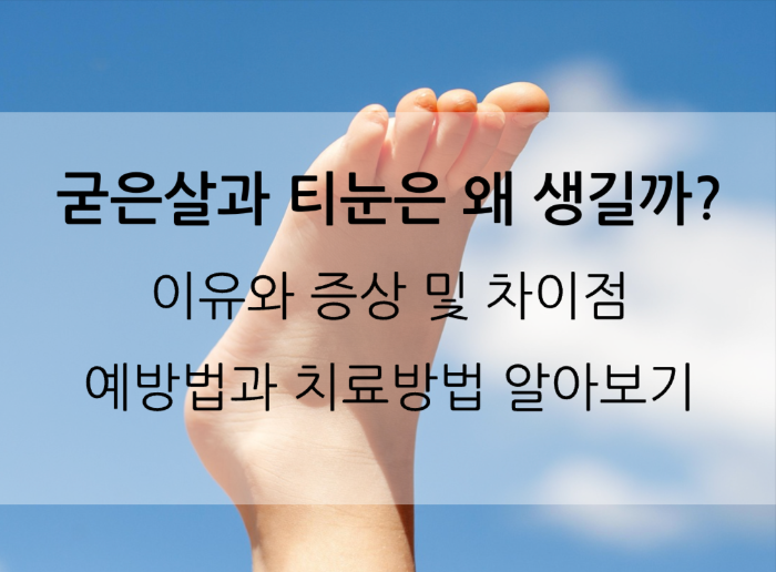 굳은살과 티눈