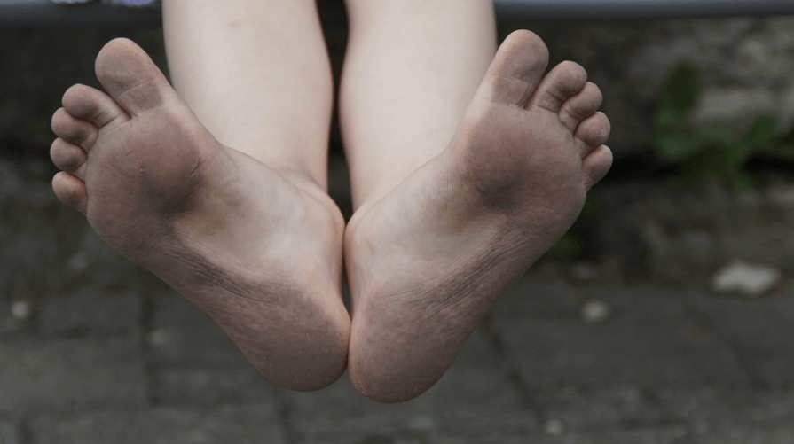 티눈 생기는 이유와 티눈 종류 및 예방법과 치료 방법 - 6