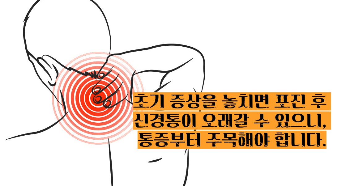 대상포진 초기증상