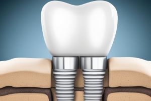 용인시-기흥구-임플란트-치과-가격-비용-싼-곳,저렴한-곳,잘하는-곳,유명한-곳-BEST20-추천17