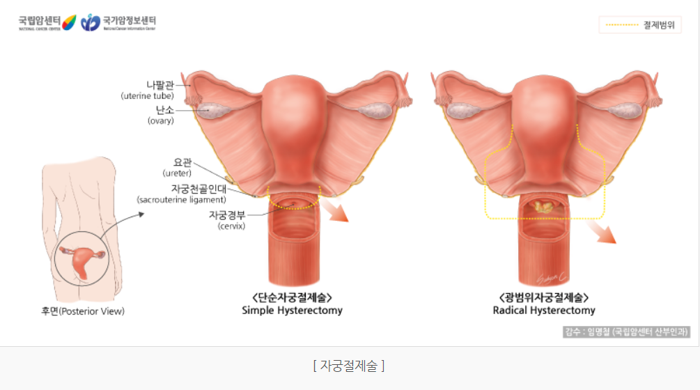 자궁절제술