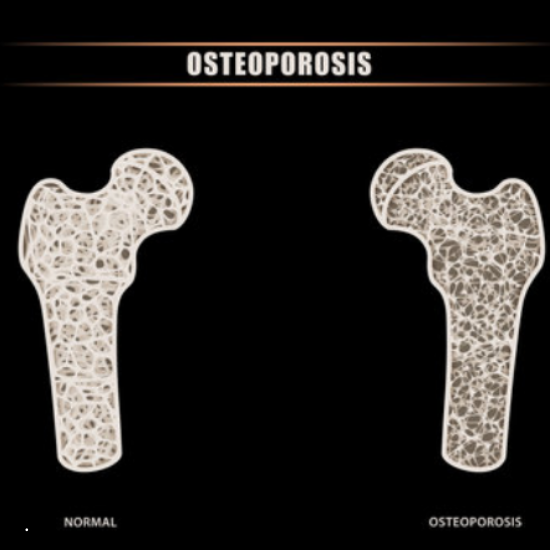 겨울철 골다공증 환자를 위한 골절 예방 가이드