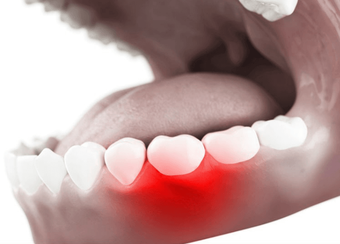 임플란트-주위염-치료하는-3가지-방법