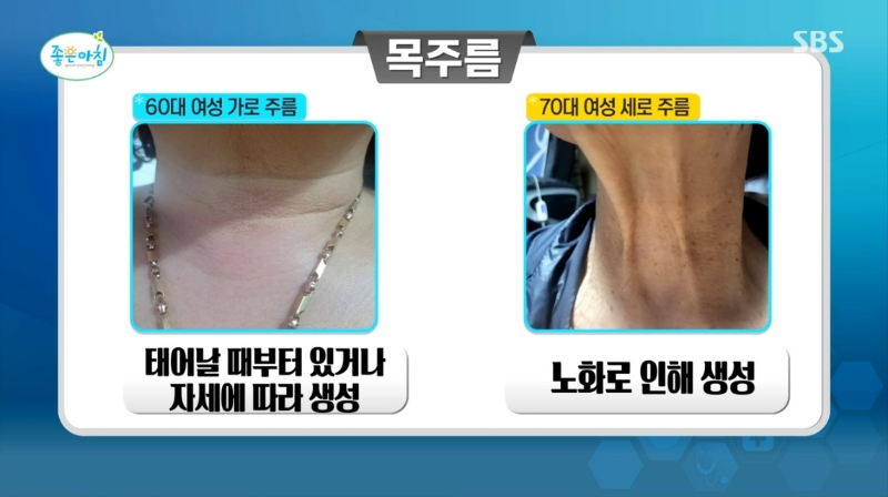 목 주름 피부 노화 예방 방법