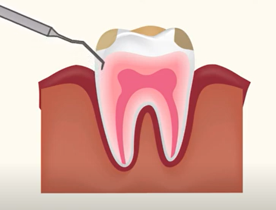 치주염의 원인 및 증상