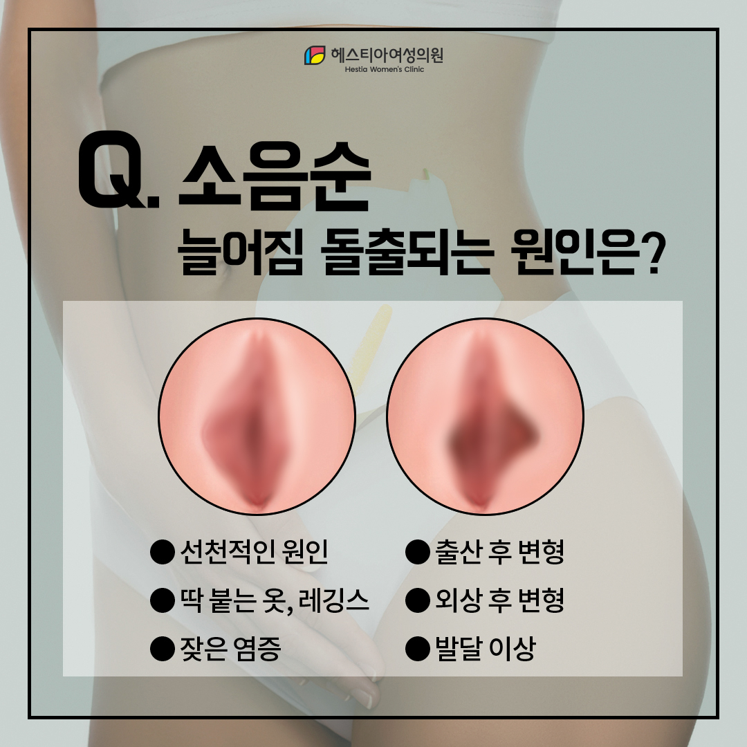 소음순늘어짐 변형이 발생하는 이유는?