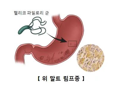 위 말트 림프종
