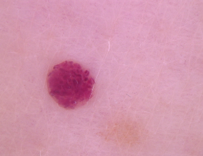 체리혈관종의 증상