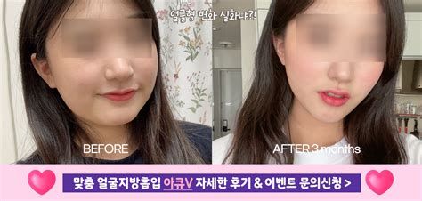 지방흡입술가격