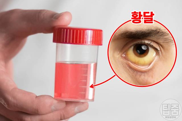 위암 증상,위암 초기증상 자가진단,소변색깔 붉은색