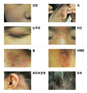 얼굴 간지러움