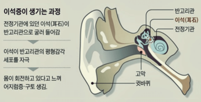 이석증이 생기는 과정 사진