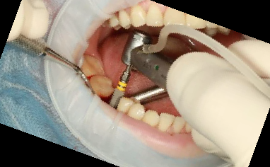 임플란트 가격 종류 비용