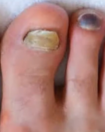 발톱이 검게 변하는 이유