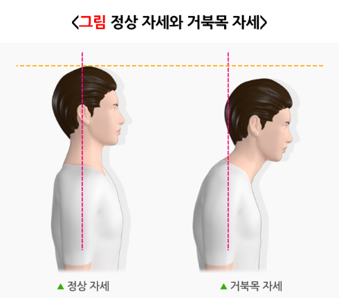 정상 자세와 거북목 자세