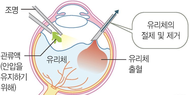 당뇨망막병증