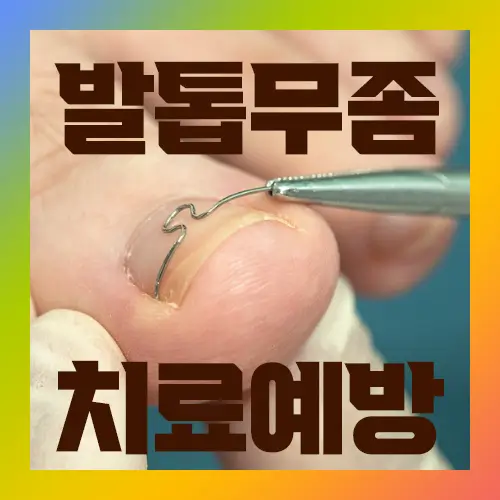 발톱무좀 치료예방