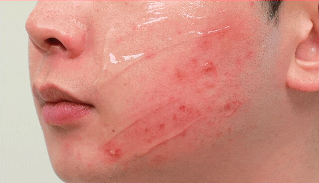 닥터윈트 레드 바하겔 &amp;#44;마스크 벗은 후 내 피부는