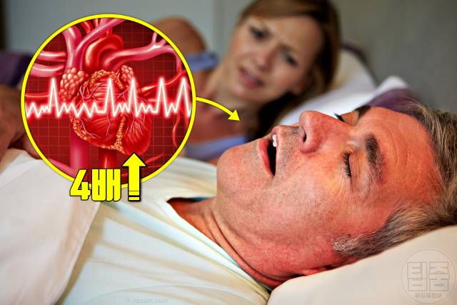 심장이 불규칙하게 뛰는 이유 심방세동 부정맥 원인 수면무호흡증 코골이