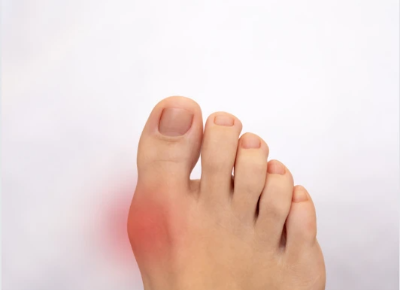 통풍에 좋은 음식 해로운 음식, 증상