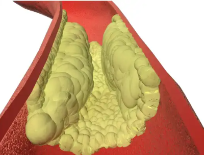고지혈증에 좋은 음식&amp;#44; 피해야 할 나쁜 음식