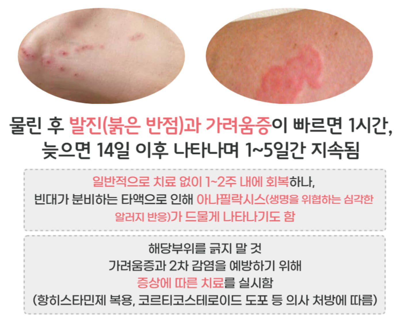 빈대 물렸을때 치료법