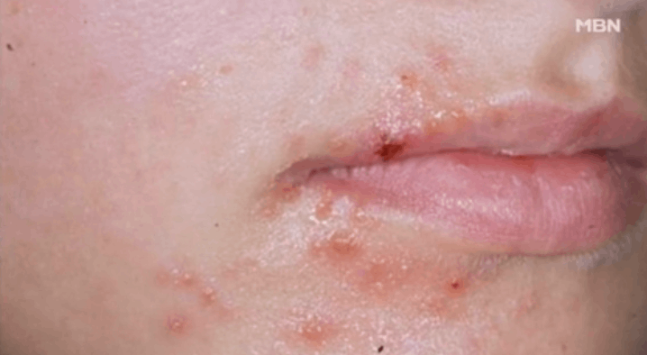 헤르페스 2형 바이러스 원인